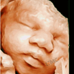 4d Scan test Photo of a baby taken at Lucknow fetal Medicine Centre - LFMC