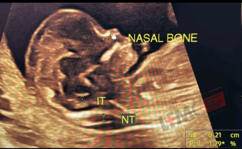 Nt nb scan test photo of a baby taken at Lucknow fetal Medicine Centre - LFMC